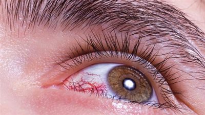 9 أسباب لظهور الشعيرات الدموية في العين